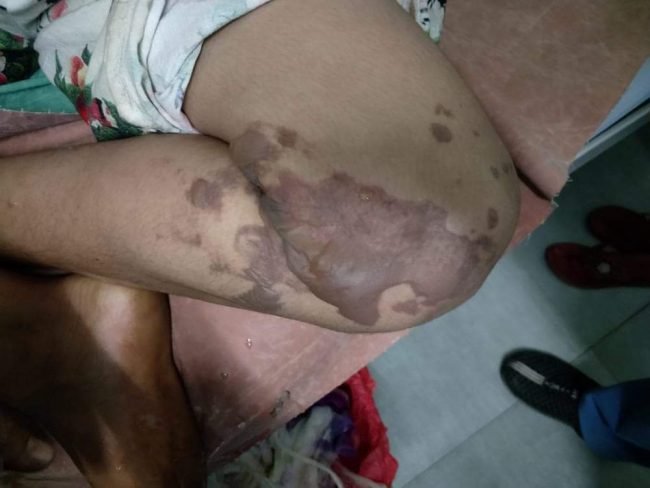 श्रीमतीमाथि तातो तेल खन्याएपछि…