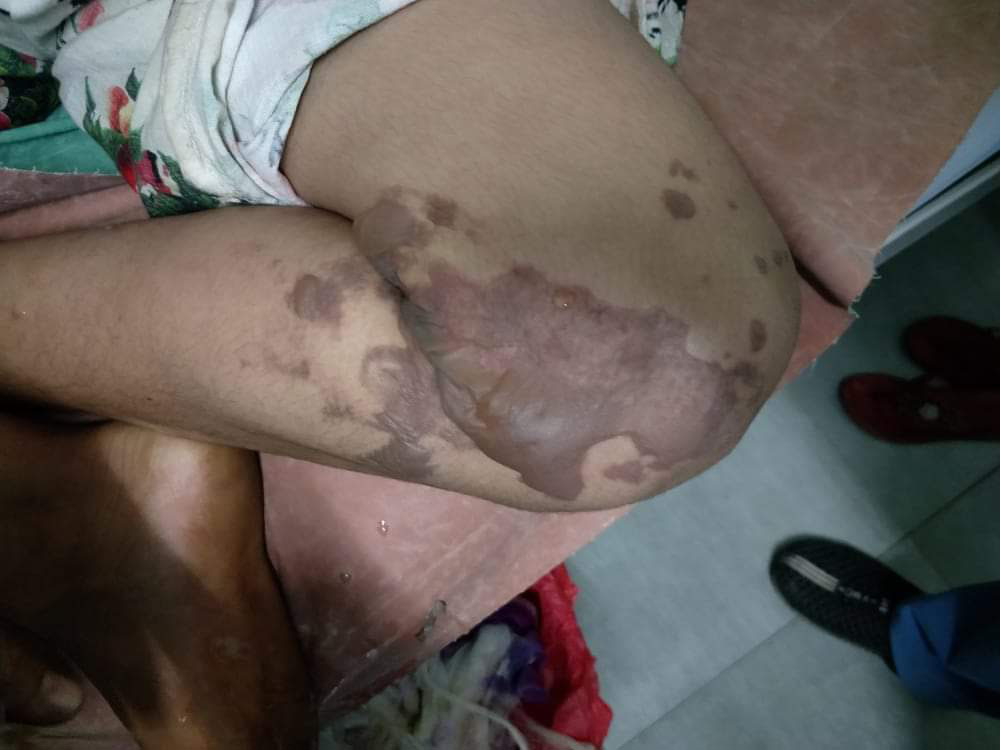 श्रीमतीमाथि तातो तेल खन्याएपछि…