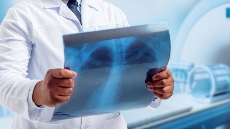 कोरोना भाइरस सङ्क्रमणले फोक्सोमा दीर्घकालीन असर