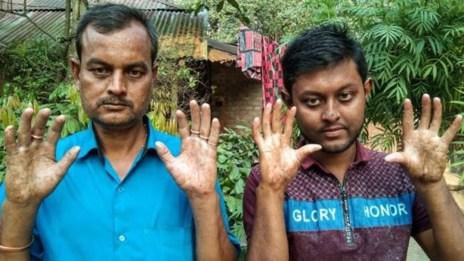 एउटा यस्तो परिवार जहाँ सबै पुरुष सदस्यका औँलामा कुनै छाप छैन