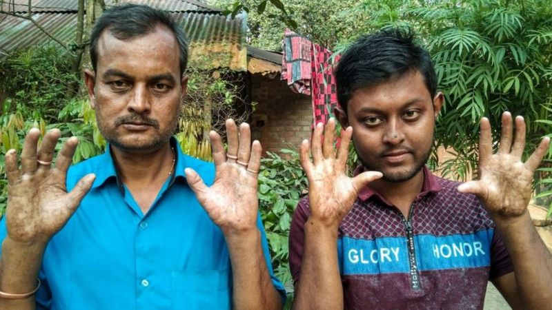 एउटा यस्तो परिवार जहाँ सबै पुरुष सदस्यका औँलामा कुनै छाप छैन