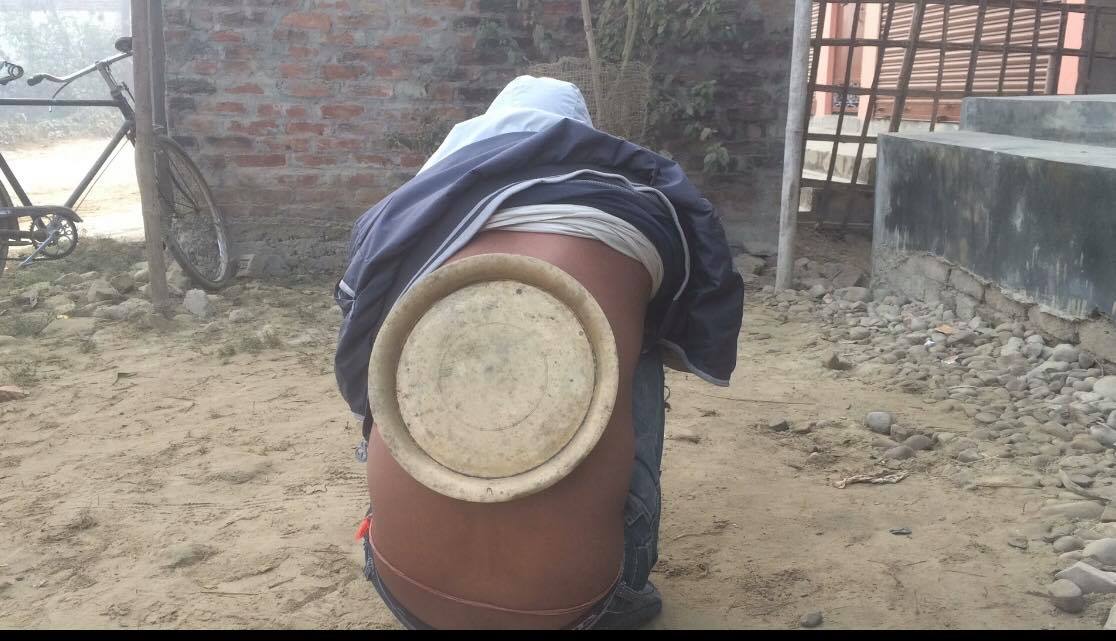 पिठ्यूँमा थाल टाँसेर कुकुरले टोकेको उपचार