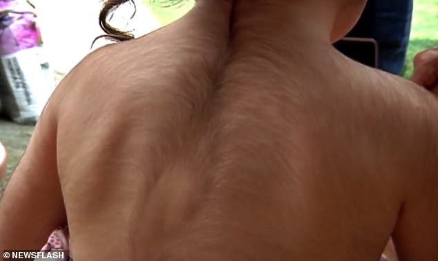 बालबालिकालाई पेट दुखेको र ग्याष्ट्रिकको औषधि दिँदा गल्ती, शरीरभरी उम्रियो कपाल