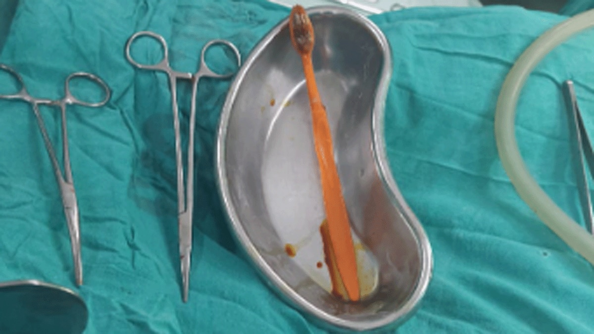 ब्रश गर्दा पेटमा छिर्‍यो ब्रश, डाक्टरले यसरी बचाए ज्यान