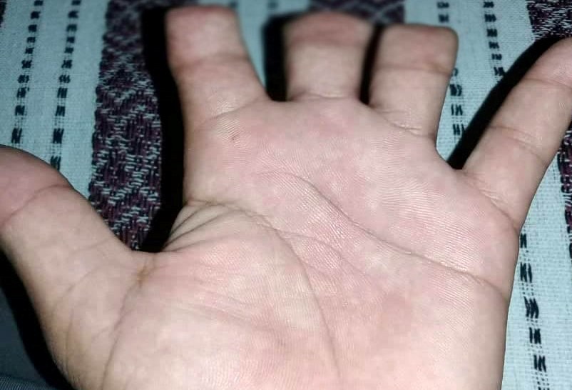 विदेशमा मेशीनले हातको औंला काटिएका प्रकाशलाई आर्थिक सहयोग