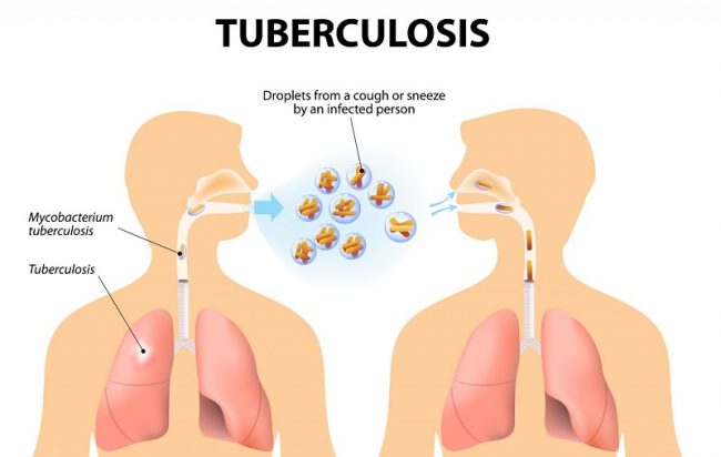 २०३६ सालबाट लगातार क्षयरोगका बिरामी खोज्दै  संस्था