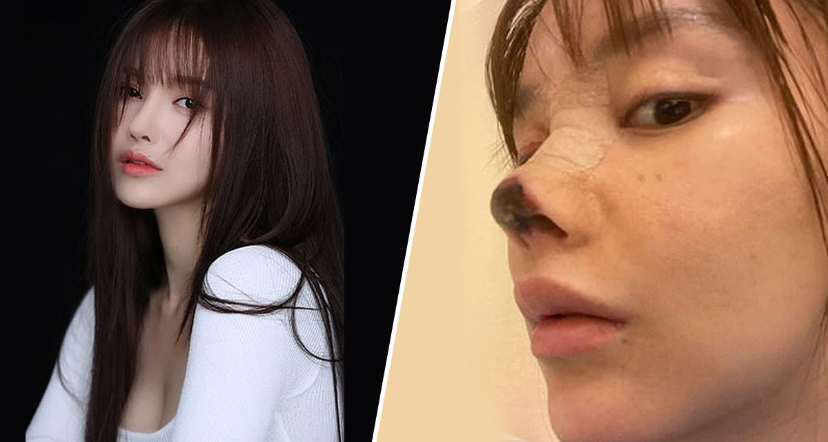 चर्चित अभिनेत्रीले प्लास्टिक सर्जरी गराउँदा नाकको भयो यस्तो हाल