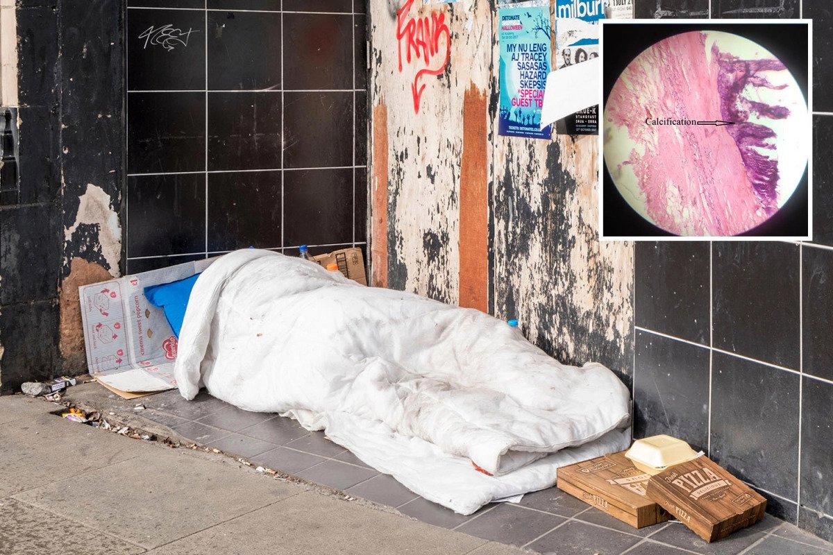 साँच्चिकै ढुङ्गाको मुटु ! मुटु ढुङगामा परिणत भएपछि घरबारविहीन व्यक्तिको मृत्यु