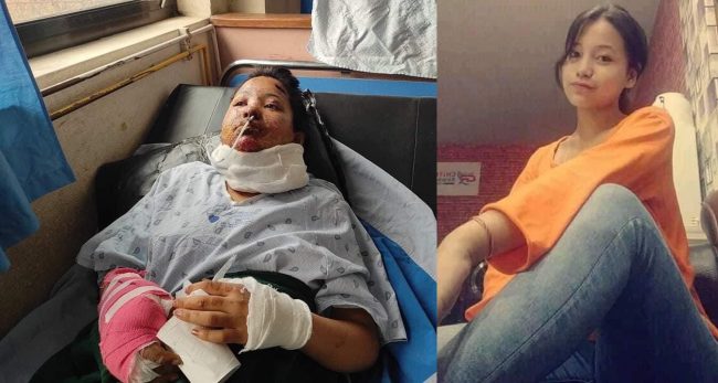 पूजा कार्कीः जसलाई फेसबुकबाट नजिकिएका ‘साथी’ले जिउँदै मट्टितेल छर्केर आगो लगाइदिए