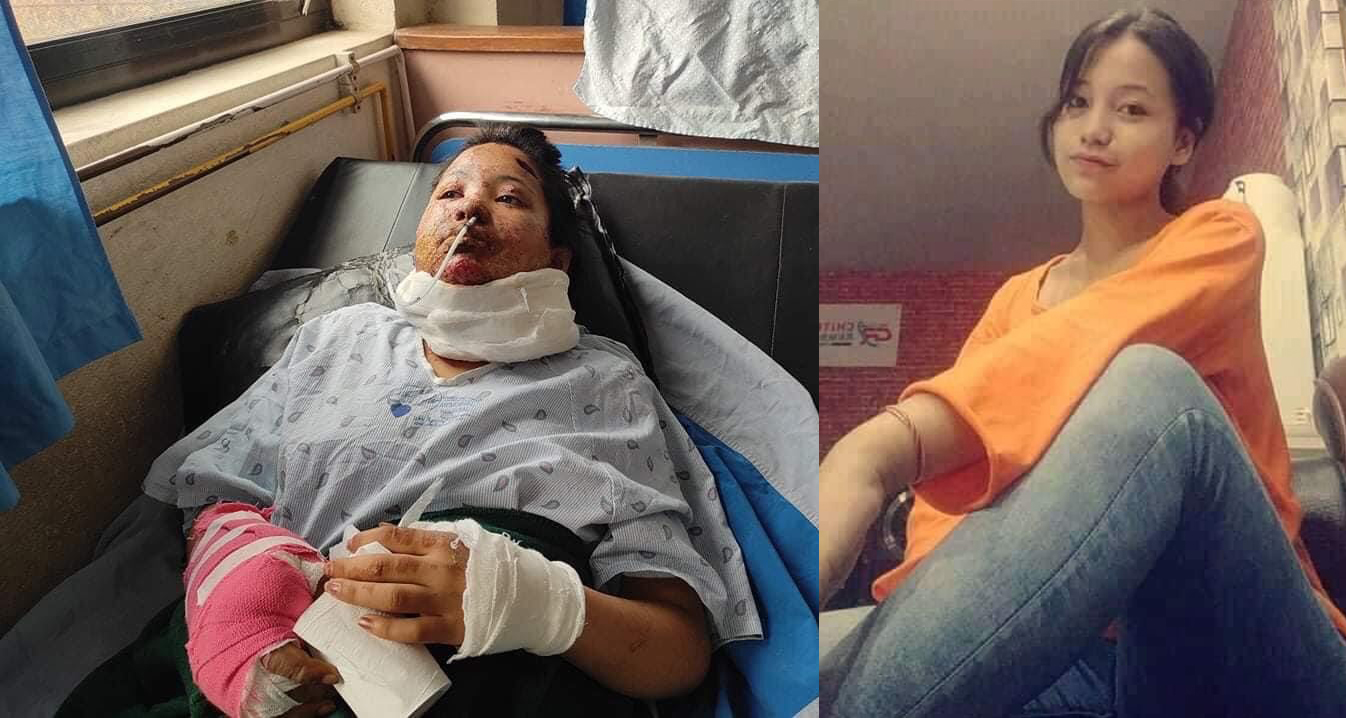 पूजा कार्कीः जसलाई फेसबुकबाट नजिकिएका ‘साथी’ले जिउँदै मट्टितेल छर्केर आगो लगाइदिए