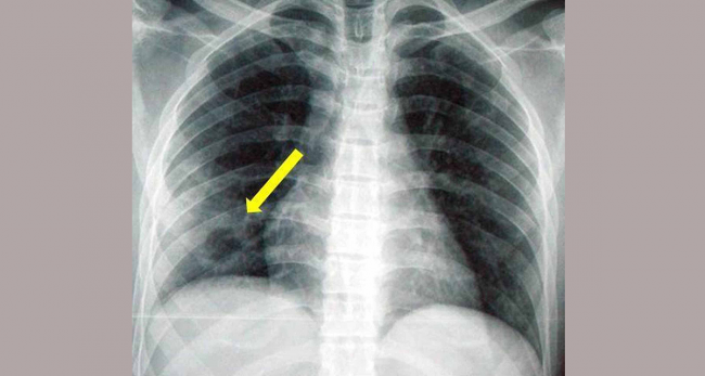 कालो ढुसीपछि सेतो ढुसीको प्रकोप, कोरोना हो वा सेतो ढुसी लक्षणबाट छुट्याउनै मुस्किल
