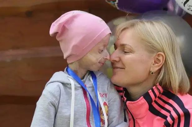 १० वर्षको उमेरमा ८० वर्ष उमेरको बुढो शरीर भएकी बालिकाको मृत्यु