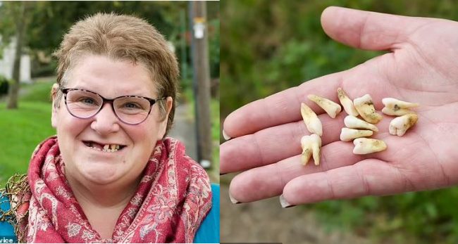 निजी डेन्टिस्ट महंगो भयो, ६ वर्षसम्म सरकारी पाइएन, महिलाले आफैं ११ वटा दाँत उखेलिन्