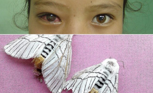 प्रकोप बन्दै शापु रोग, बालबालिका उच्च जोखिममा