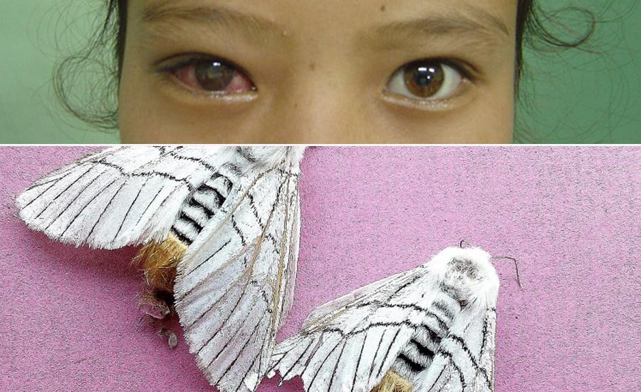 प्रकोप बन्दै शापु रोग, बालबालिका उच्च जोखिममा