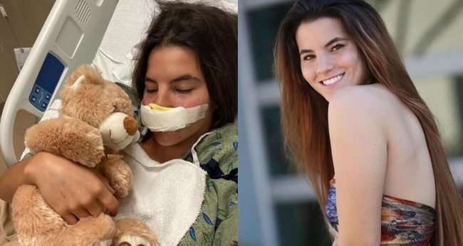 आफन्तको कुकुरले खाइदियो मोडलको ओठ, उपचार गर्न ५ करोड खर्च