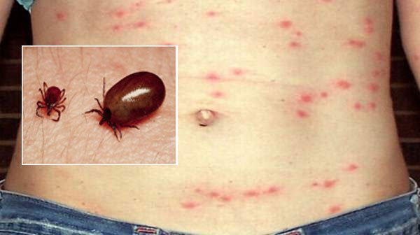 स्क्रव टाइफसबाट गोरखामा पहिलो पटक मान्छेको मृत्यु