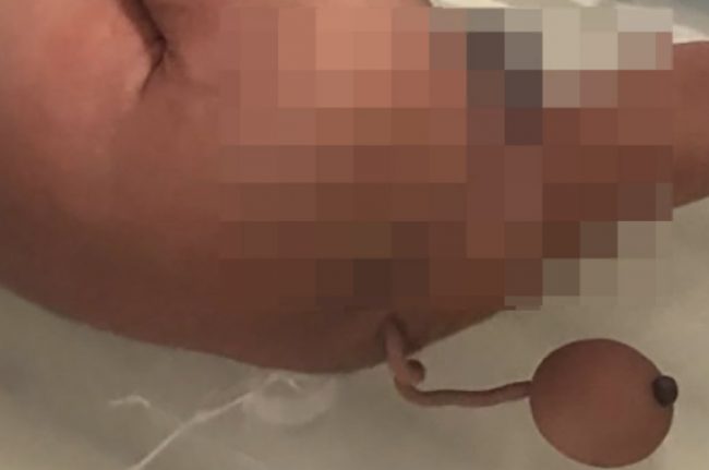 १० सेन्टिमिटरको पुच्छर भएको बच्चा जन्मियो