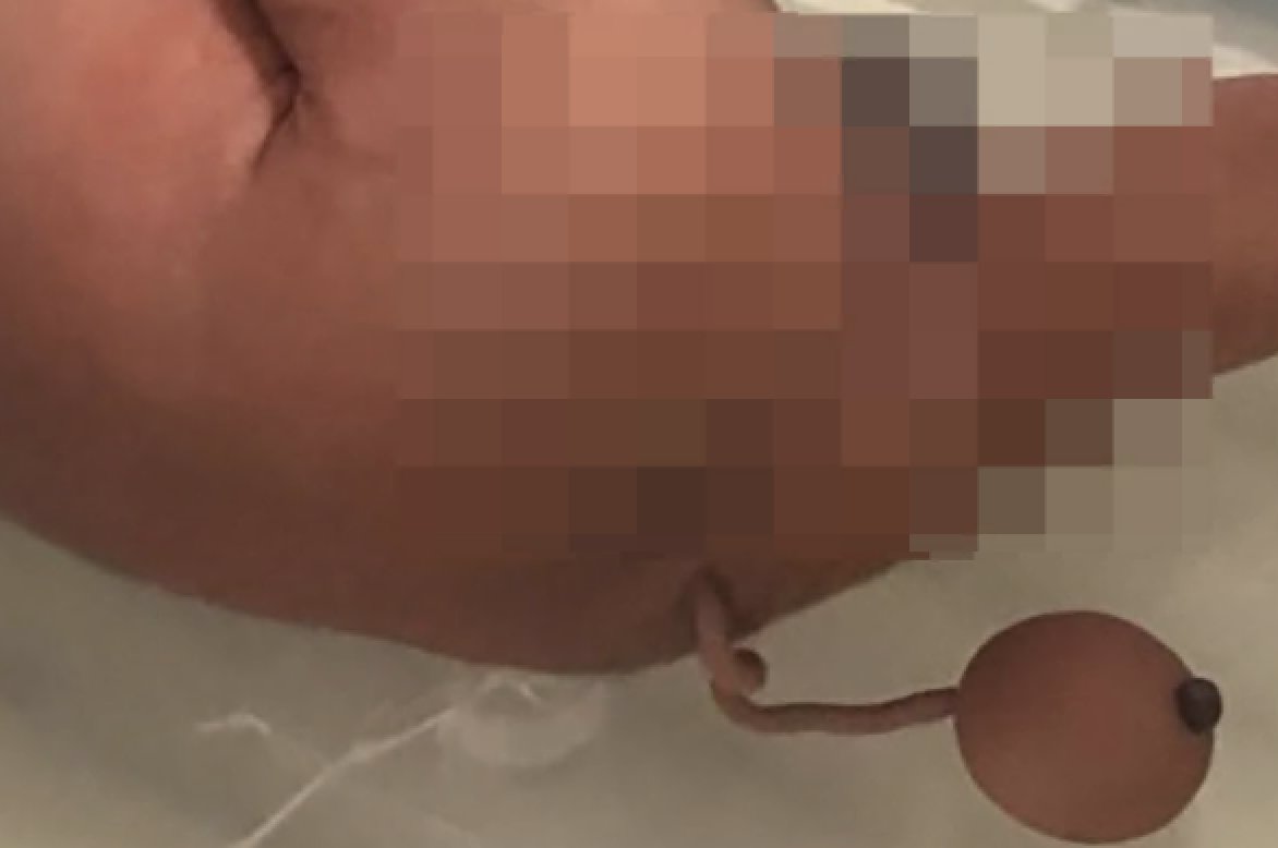 १० सेन्टिमिटरको पुच्छर भएको बच्चा जन्मियो