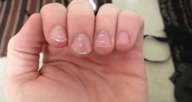 शरीरमा यी तत्वको कमी भएमा नङमा देखिन्छ सेतो दाग, बेवास्ता नगर्नुहोस्