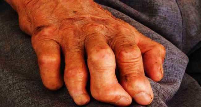 नवलपरासी पूर्वमा २८ कुष्ठरोगी उपचाररत