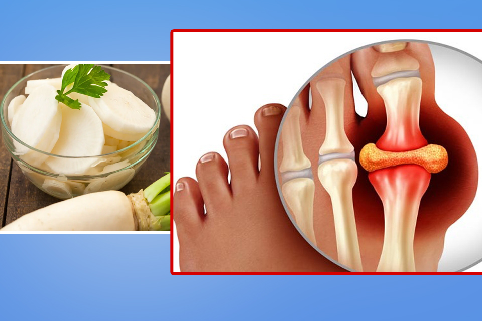 युरिक एसिडमा मूला खानुहोस्, यस्ता छन् फाइदाहरु