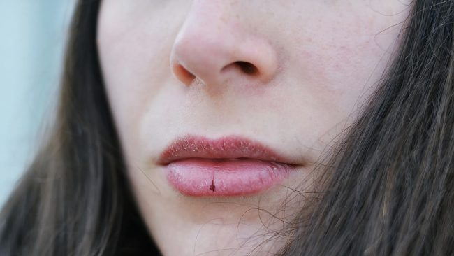 जाडोमा ओठ फुटेको छ ? अपनाउँनुहोस् यी घरेलु उपाय