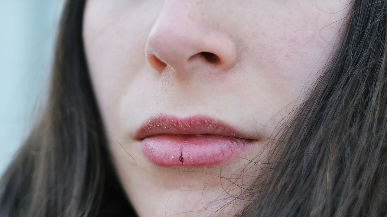 जाडोमा ओठ फुटेको छ ? अपनाउँनुहोस् यी घरेलु उपाय