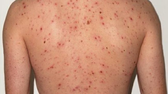 दाङ र कालीकोटमा पनि देखियो दादुरा