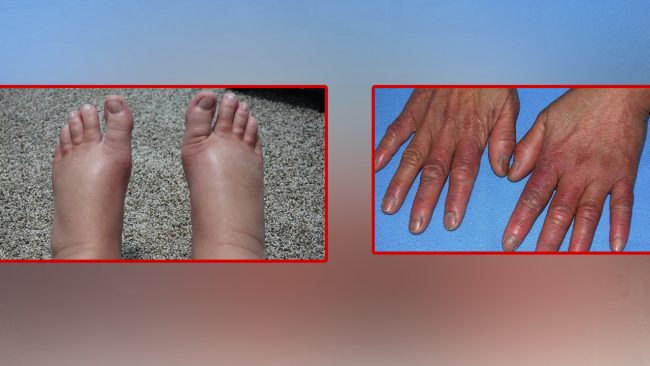 जाडोमा हात खुट्टका औंलाहरू सुन्निन्छ? यी घरेलु उपाय अपनाउनुहोस्