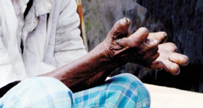 म्याग्दीमा कुष्ठरोगका नयाँ बिरामी देखिएन