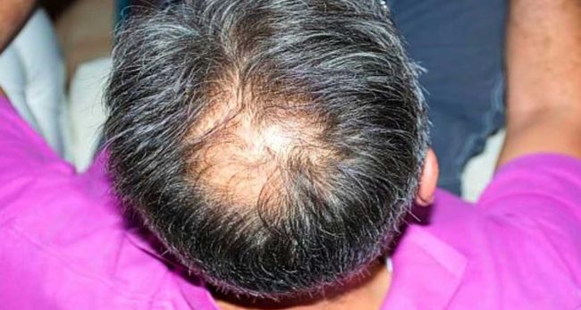 बिस्तारै कपाल झरेर तालु खुइलिदै छ ? कपाल झर्न रोक्न अपनाउनुहोस् यी घरेलु उपायहरु