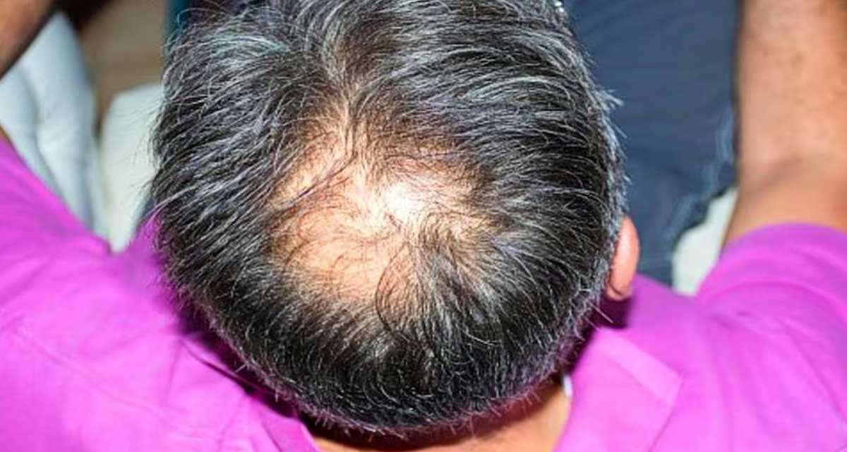 बिस्तारै कपाल झरेर तालु खुइलिदै छ ? कपाल झर्न रोक्न अपनाउनुहोस् यी घरेलु उपायहरु