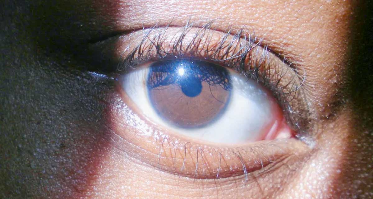 हाई कोलेस्ट्रोलका कारण गुम्न सक्छ आँखाको ज्योति, यी संकेतहरूलाई बेवास्ता नगर्नुहोस्