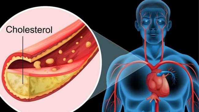 यी ५ तरकारीले बढ्न दिदैंन कोलेस्ट्रोल