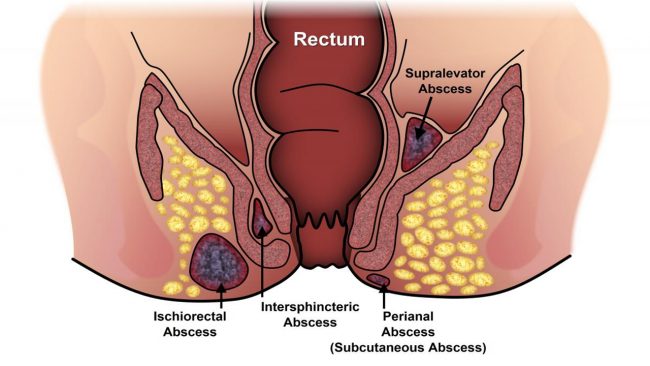 फिस्टुलाको रामबाण औषधि अश्वगन्धा, यसरी प्रयोग गर्नुहोस्