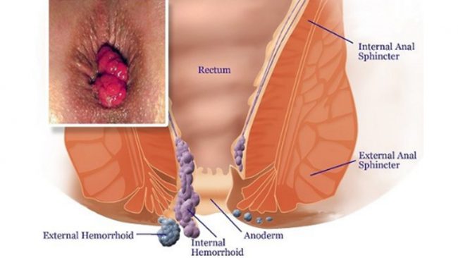 पायल्स भएको छ ? खानुहोस् दैनिक एउटा मूला, यस्ता छन् अन्य घरेलु उपाय