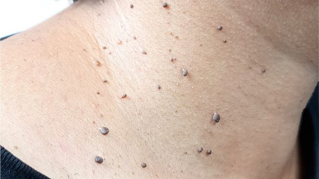 बिना दुखाइ घरमै यसरी हटाउनुहोस् स्किन ट्यागहरू