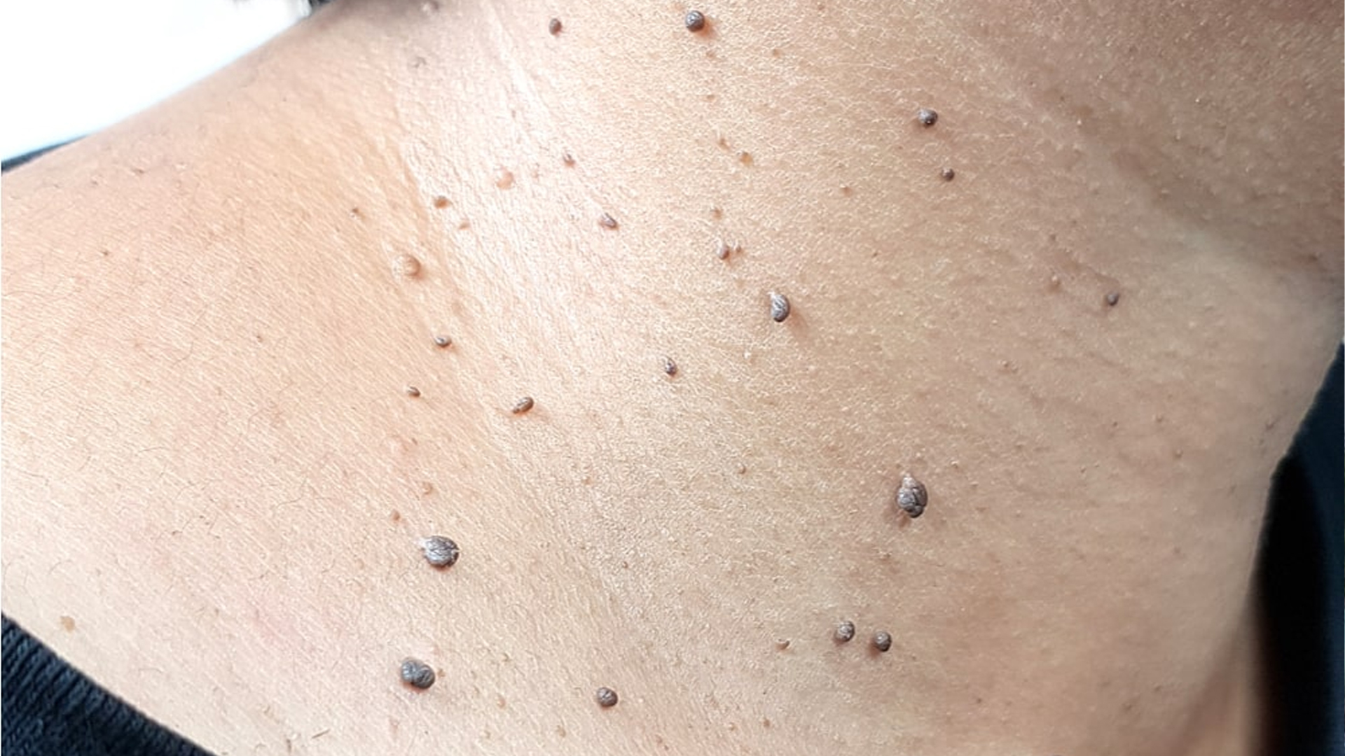 बिना दुखाइ घरमै यसरी हटाउनुहोस् स्किन ट्यागहरू