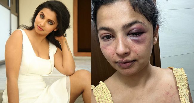 अभिनेत्रीलाई पूर्वप्रेमीले गरे निर्घात कुटपिट