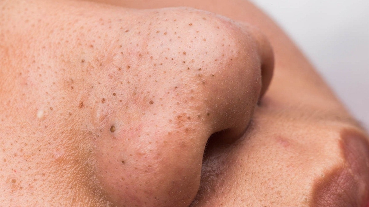 ब्ल्याकहेड्स हटाउन चाहनुहुन्छ ? लगाउनुहोस् टमाटर