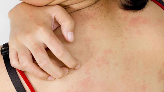 छाला सम्बन्धी यी रोगहरुबाट हैरान हुनुहुन्छ ? यस्ता छन् रोकथामका उपायहरु