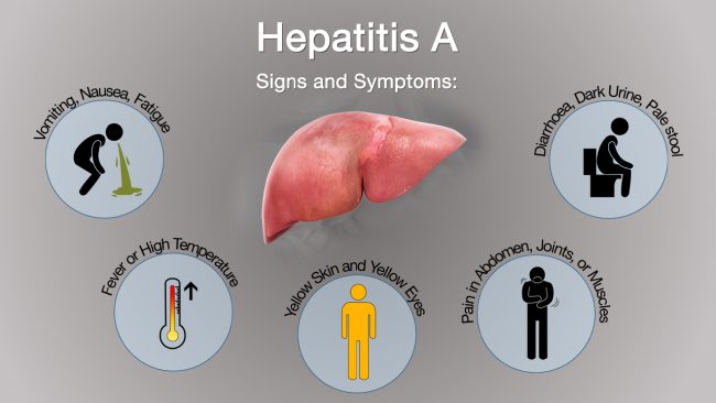 हेपाटाइटिस ए हुँदा देखिन्छ यस्तो लक्षण