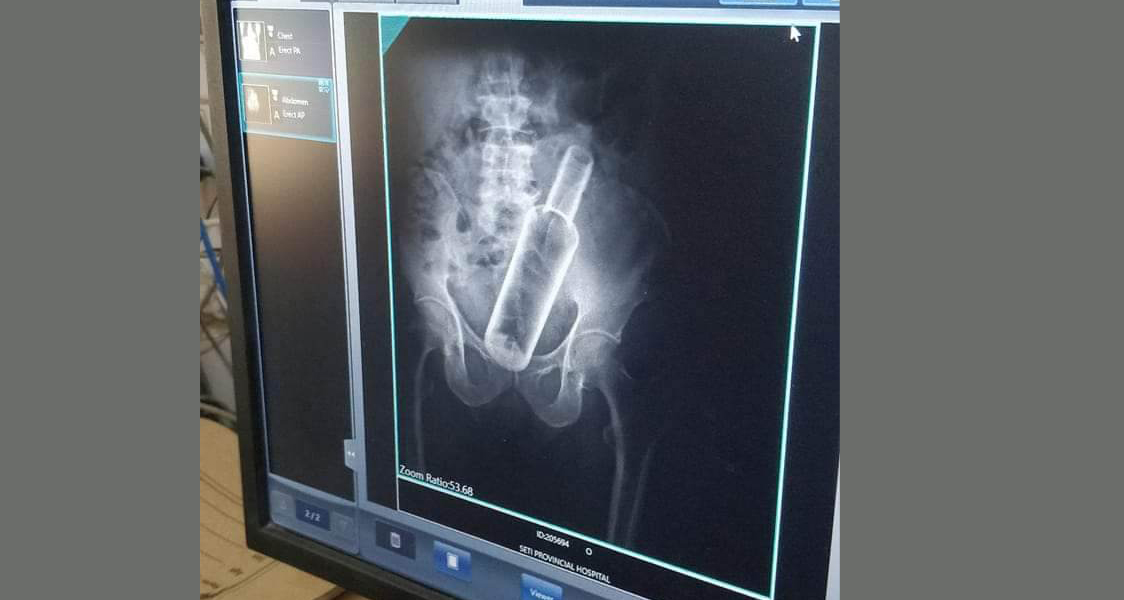 धनगढीमा एकजनाको पेटमा भेटियो भोड्काको बोतल