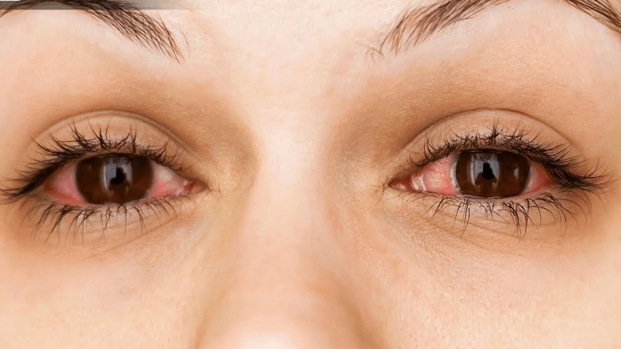 आँखा पोल्ने वा चिलाउने भएको छ ? अपनाउनुहोस् यी घरेलु उपायहरू