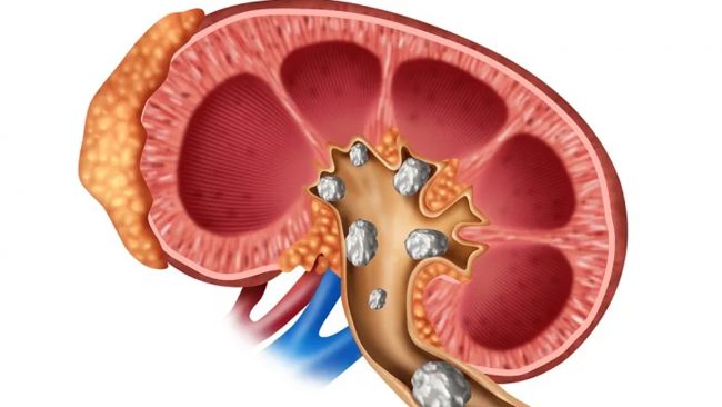 ३ तरिकाका पिसाब हेरेर पहिचान गर्नुहोस् मृगौलामा पत्थर भएको
