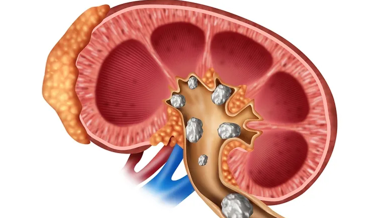 ३ तरिकाका पिसाब हेरेर पहिचान गर्नुहोस् मृगौलामा पत्थर भएको
