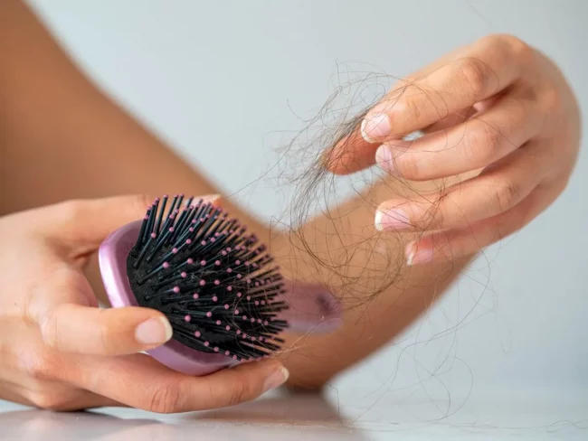 मोटोपनाले पनि झर्छ कपाल