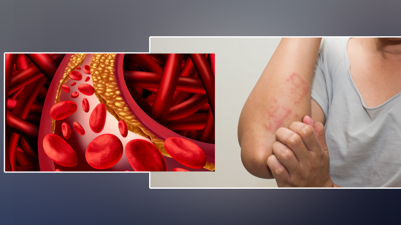 उच्च कोलेस्ट्रोल हुँदा छालामा देखिन्छन् यी लक्षण