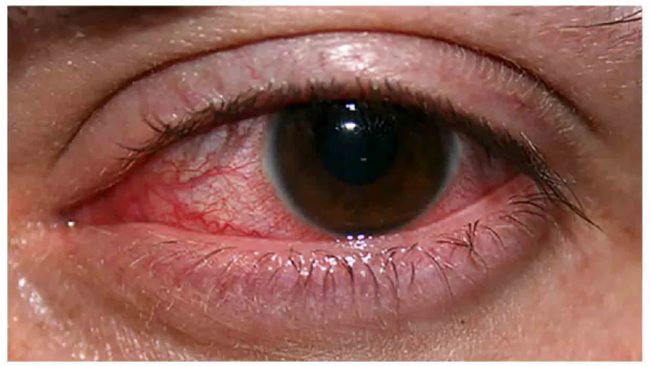 बर्षातको समयमा आँखामा हुन्छ यस्तो सरुवा रोग, अपनाउनुहोस् घरेलु उपाय
